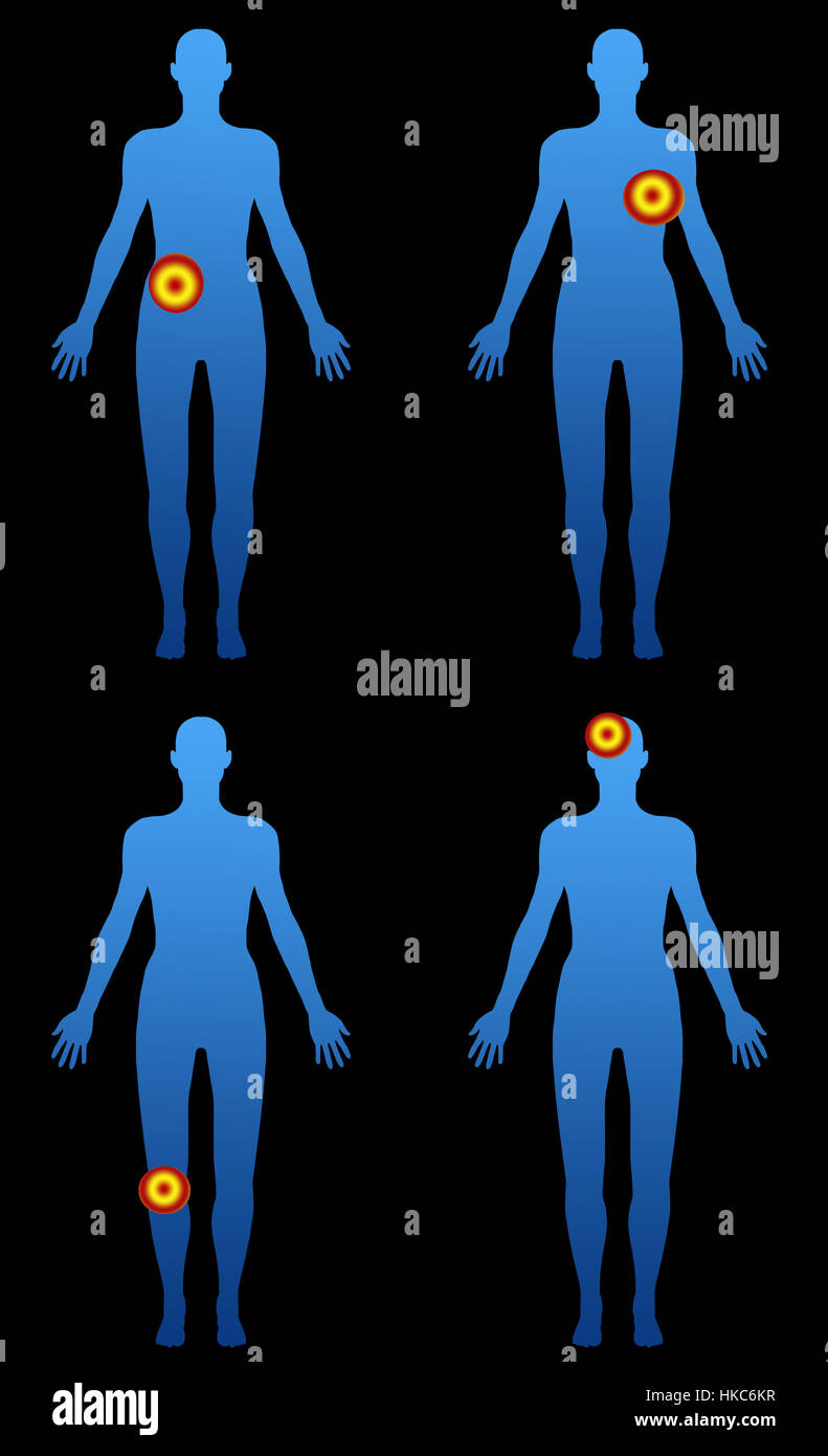 Body silhouette with localized pain zones Stock Photo