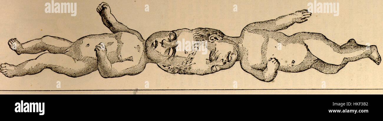 The Craniopagus Twins Is A Historical Medical Artwork Depicting The Craniopagus Twins Is A Historical Medical Artwork Depicting
