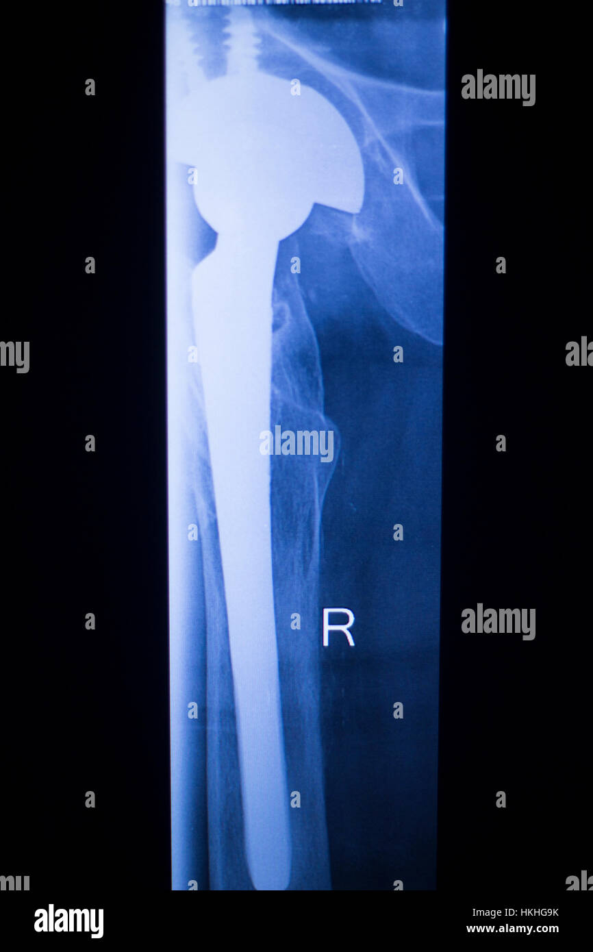 Hip ball and socket hires stock photography and images Alamy