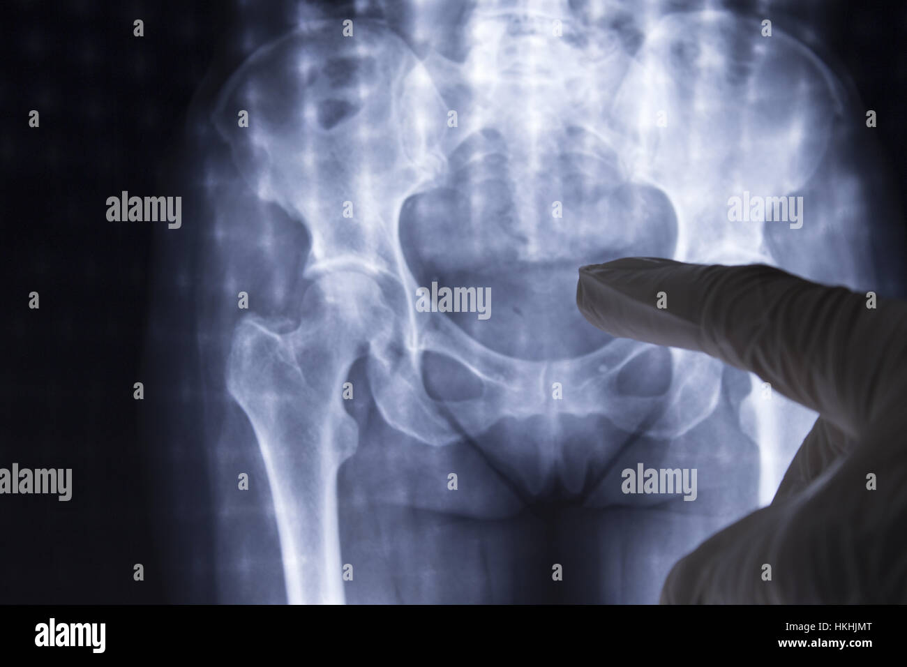 xray stock news