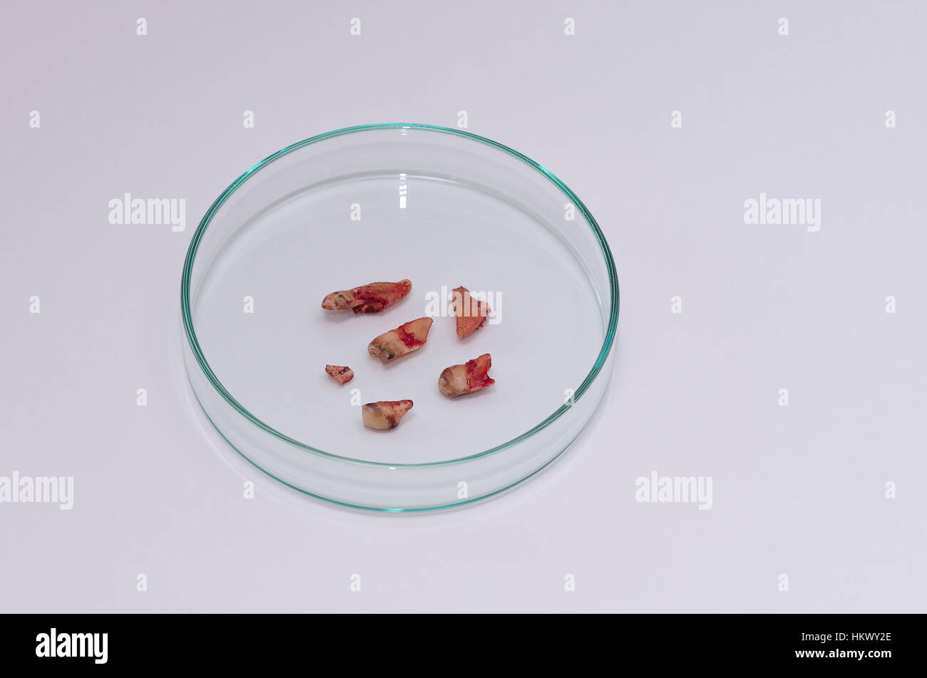 Fragments of a human tooth after extraction in a petri dish. Stock Photo