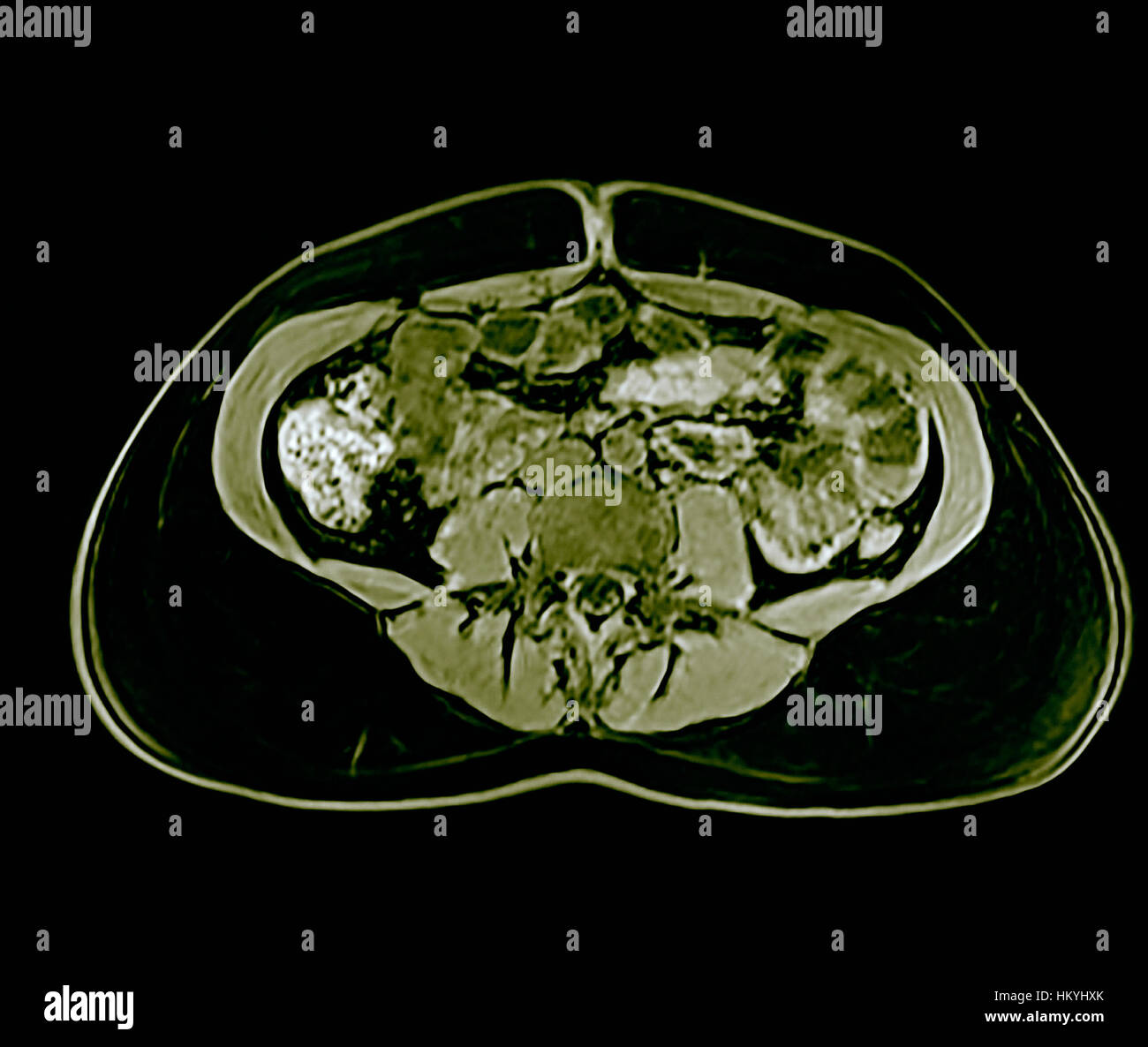 Cross section Enterography also called an gastrointestinal study or contrast radiography of the gastrointestinal tract, is a series of radiographs use Stock Photo