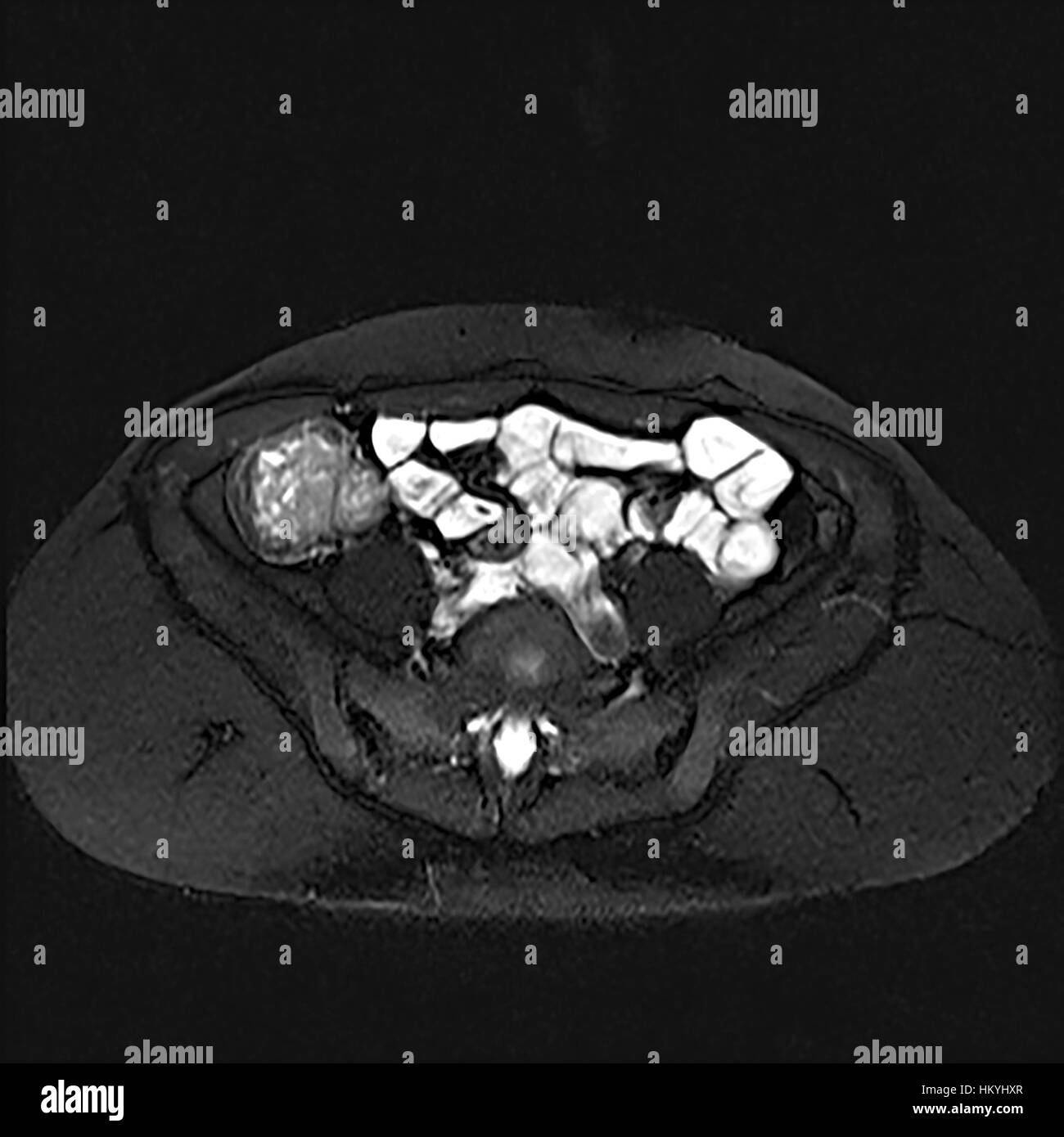 Cross section Enterography also called an gastrointestinal study or contrast radiography of the gastrointestinal tract, is a series of radiographs use Stock Photo