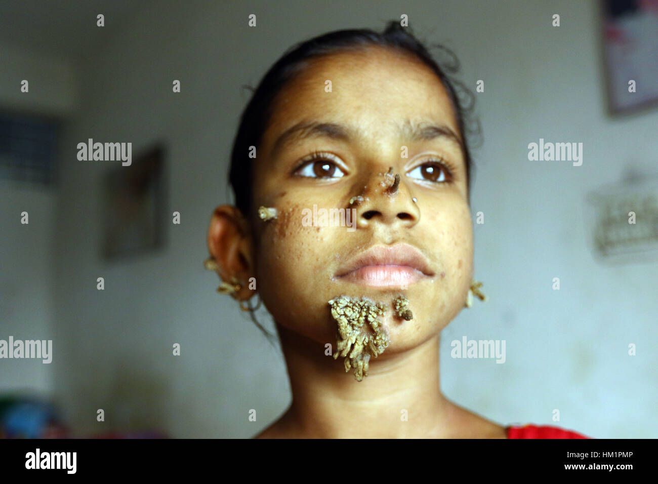 Dhaka, Bangladesh. 01 Feb, 2017. Bangladeshi patient Sahana Khatun, 10, poses for a photograph at the Dhaka Medical College and Hospital. A young Bangladeshi girl with bark-like warts growing on her face could be the first female ever afflicted by so-called 'tree man syndrome', doctors studying the rare condition said January 31. Ten-year-old Sahana Khatun has the tell-tale gnarled growths sprouting from her chin, ear and nose, but doctors at Dhaka's Medical College Hospital are still conducting tests to establish if she has the unusual skin disorder. Stock Photo