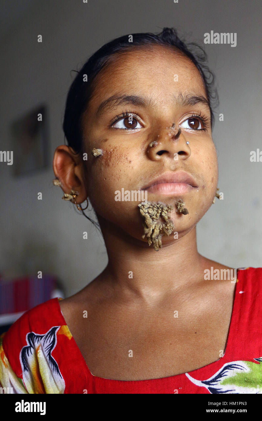 Dhaka, Bangladesh. 01 Feb, 2017. Bangladeshi patient Sahana Khatun, 10, poses for a photograph at the Dhaka Medical College and Hospital. A young Bangladeshi girl with bark-like warts growing on her face could be the first female ever afflicted by so-called 'tree man syndrome', doctors studying the rare condition said January 31. Ten-year-old Sahana Khatun has the tell-tale gnarled growths sprouting from her chin, ear and nose, but doctors at Dhaka's Medical College Hospital are still conducting tests to establish if she has the unusual skin disorder. Stock Photo