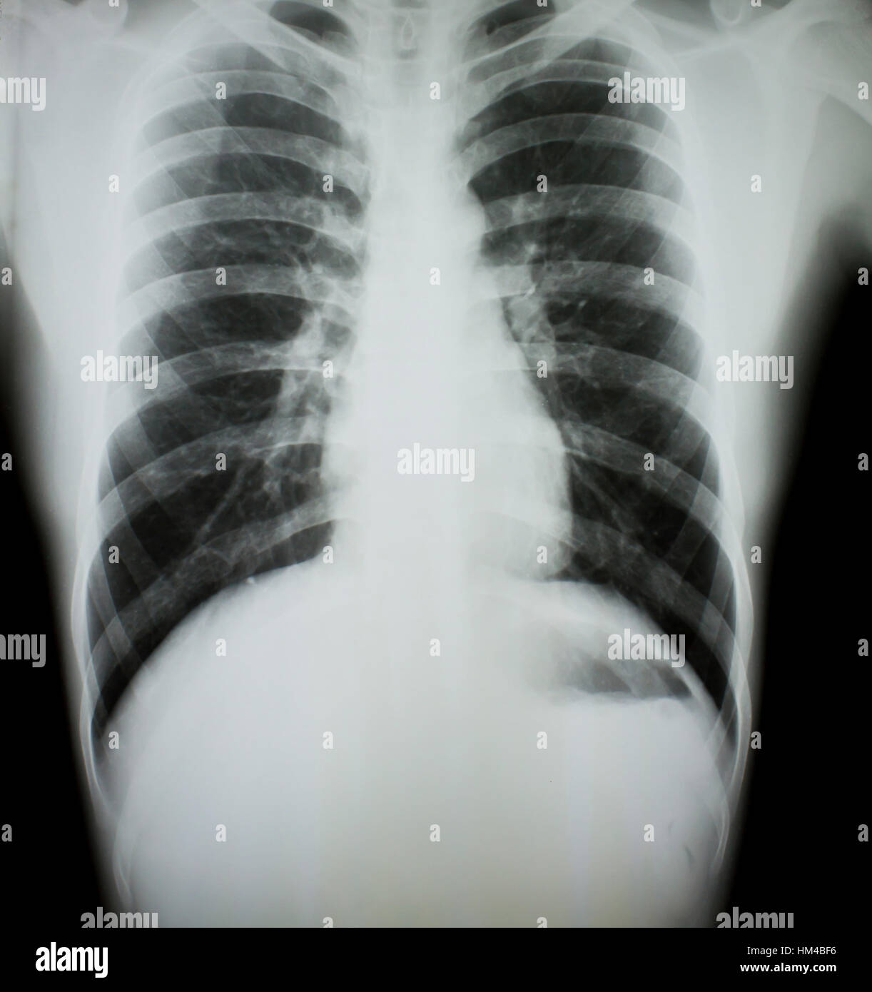 Chest xray for cough hires stock photography and images Alamy