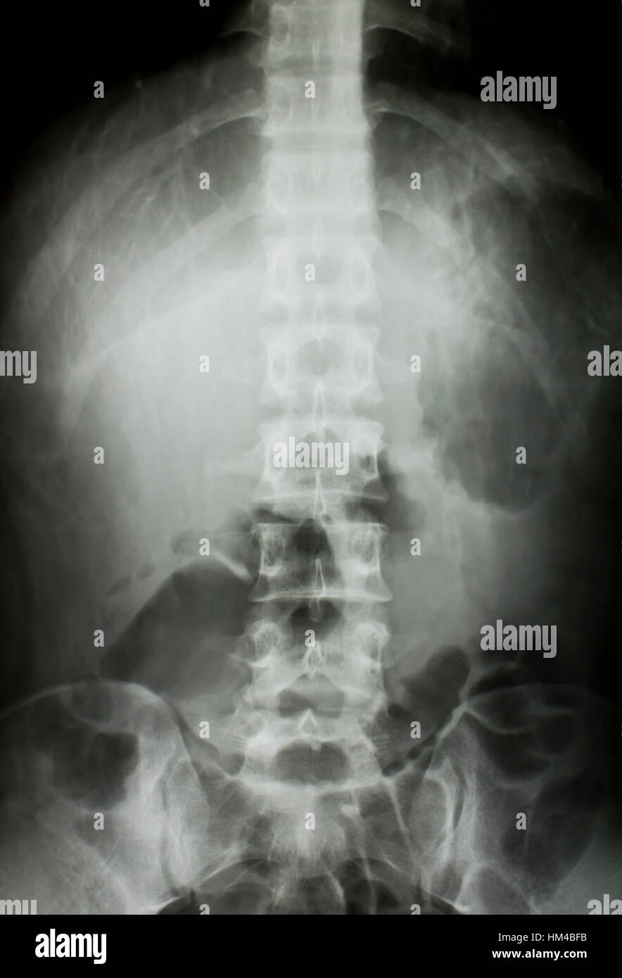 X-ray of the pelvis and spinal column Stock Photo - Alamy