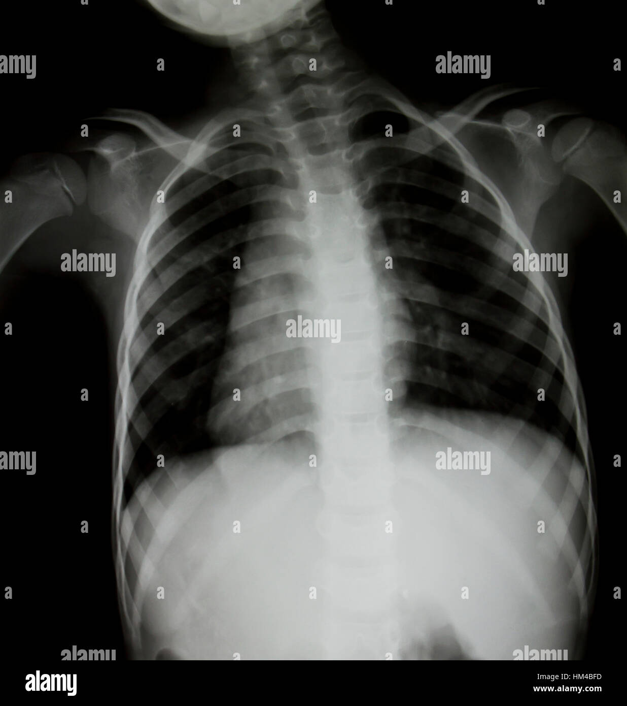 Chest x-ray of young girl. Stock Photo