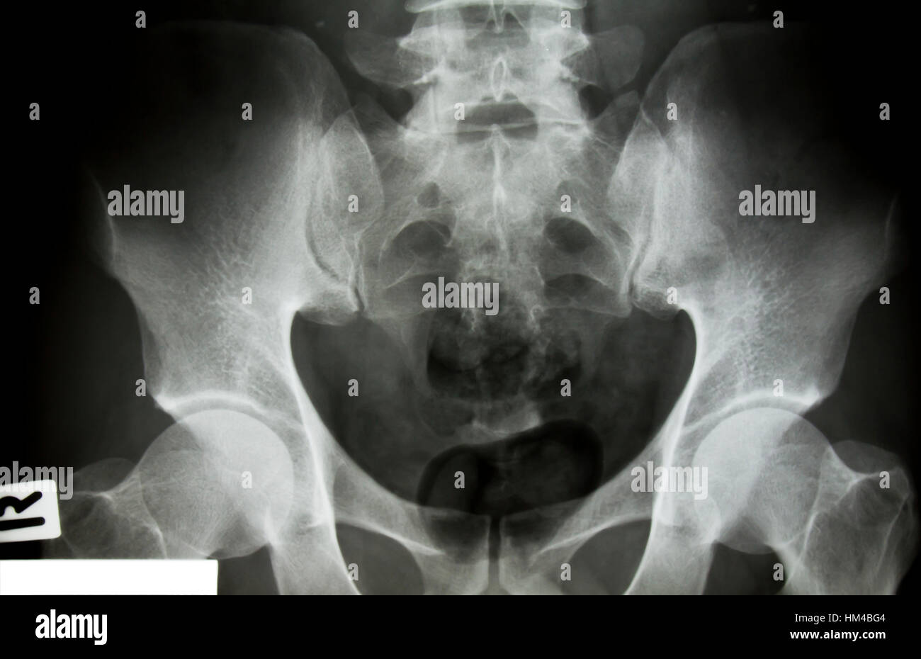 X-ray of the pelvis and spinal column Stock Photo - Alamy