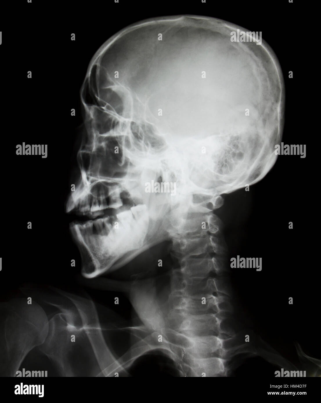 Detail of neck and head x-ray image Stock Photo - Alamy