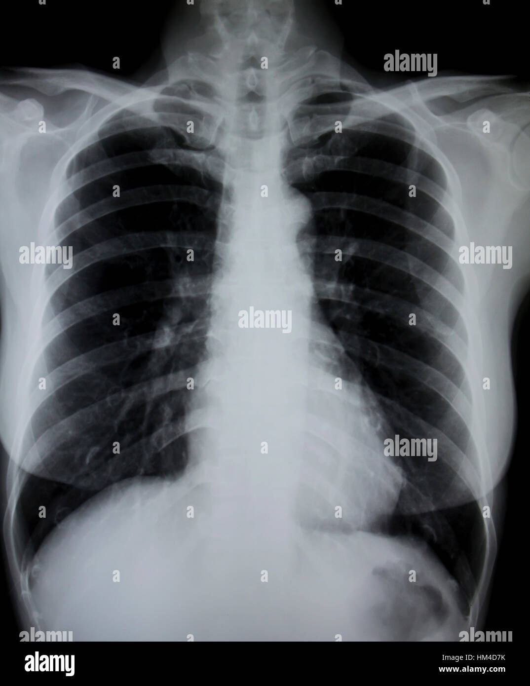 Chest x-ray. Stock Photo