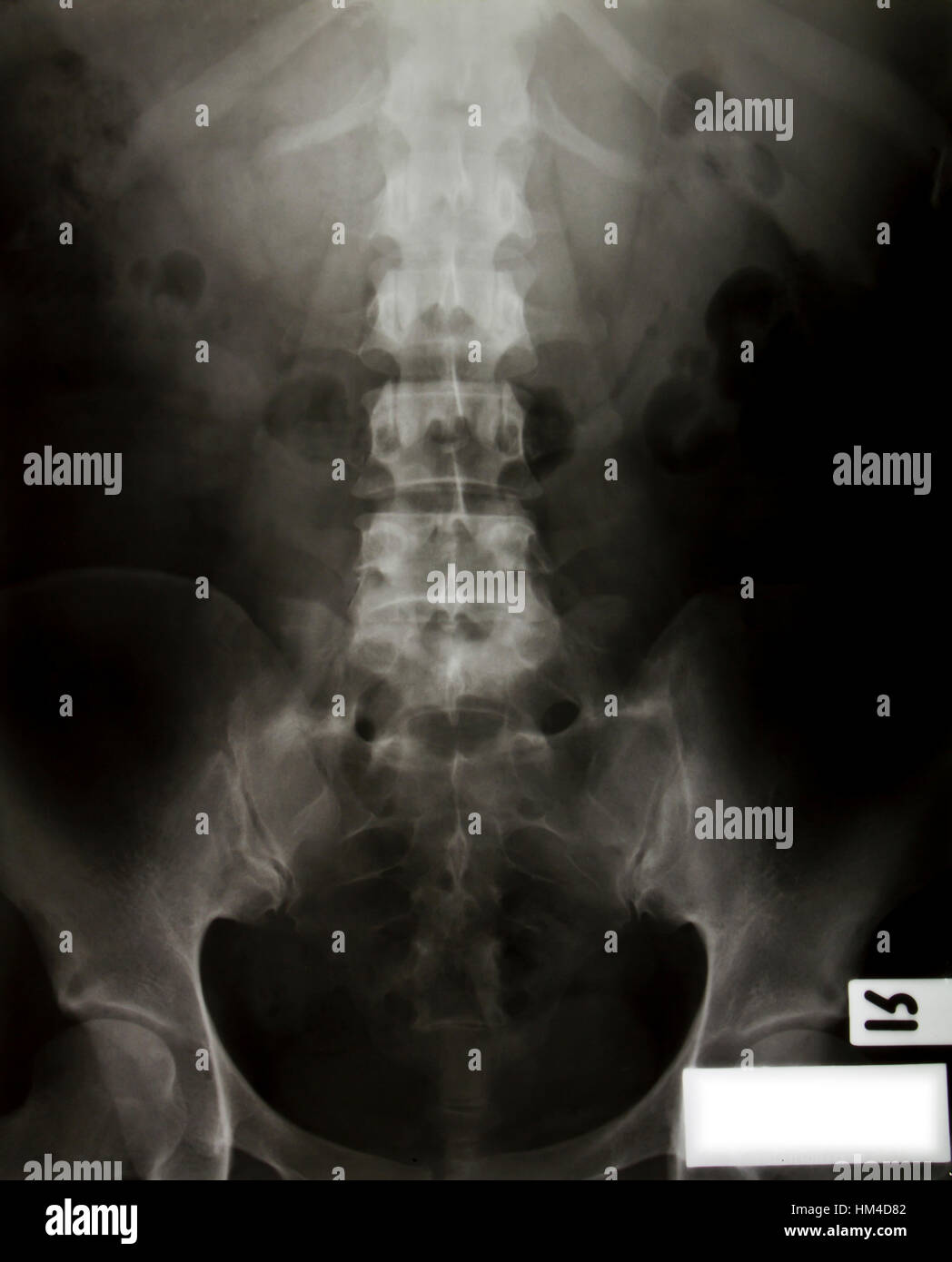 X-ray of the pelvis and spinal column Stock Photo - Alamy