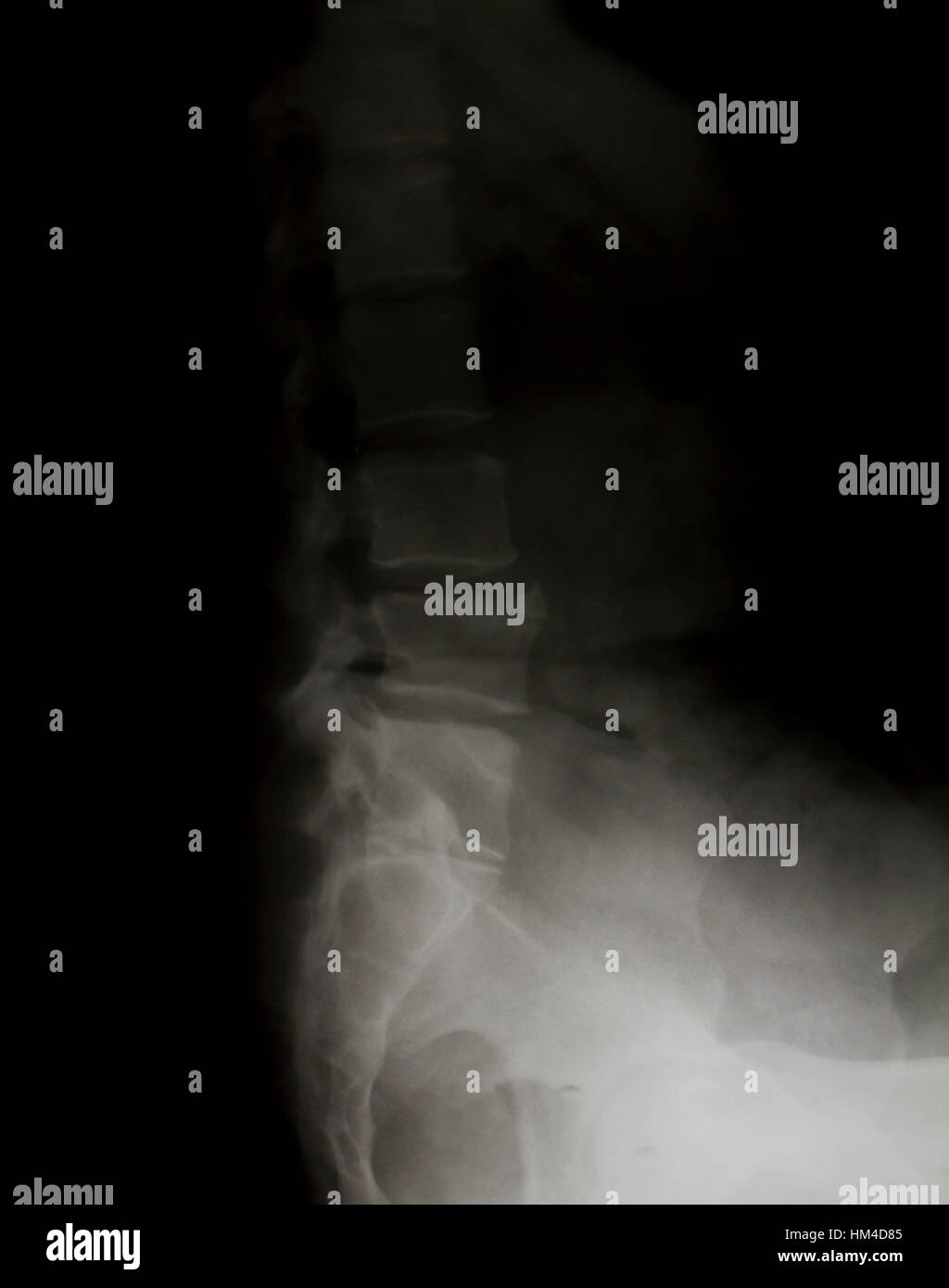 X-ray of the pelvis and spinal column Stock Photo - Alamy