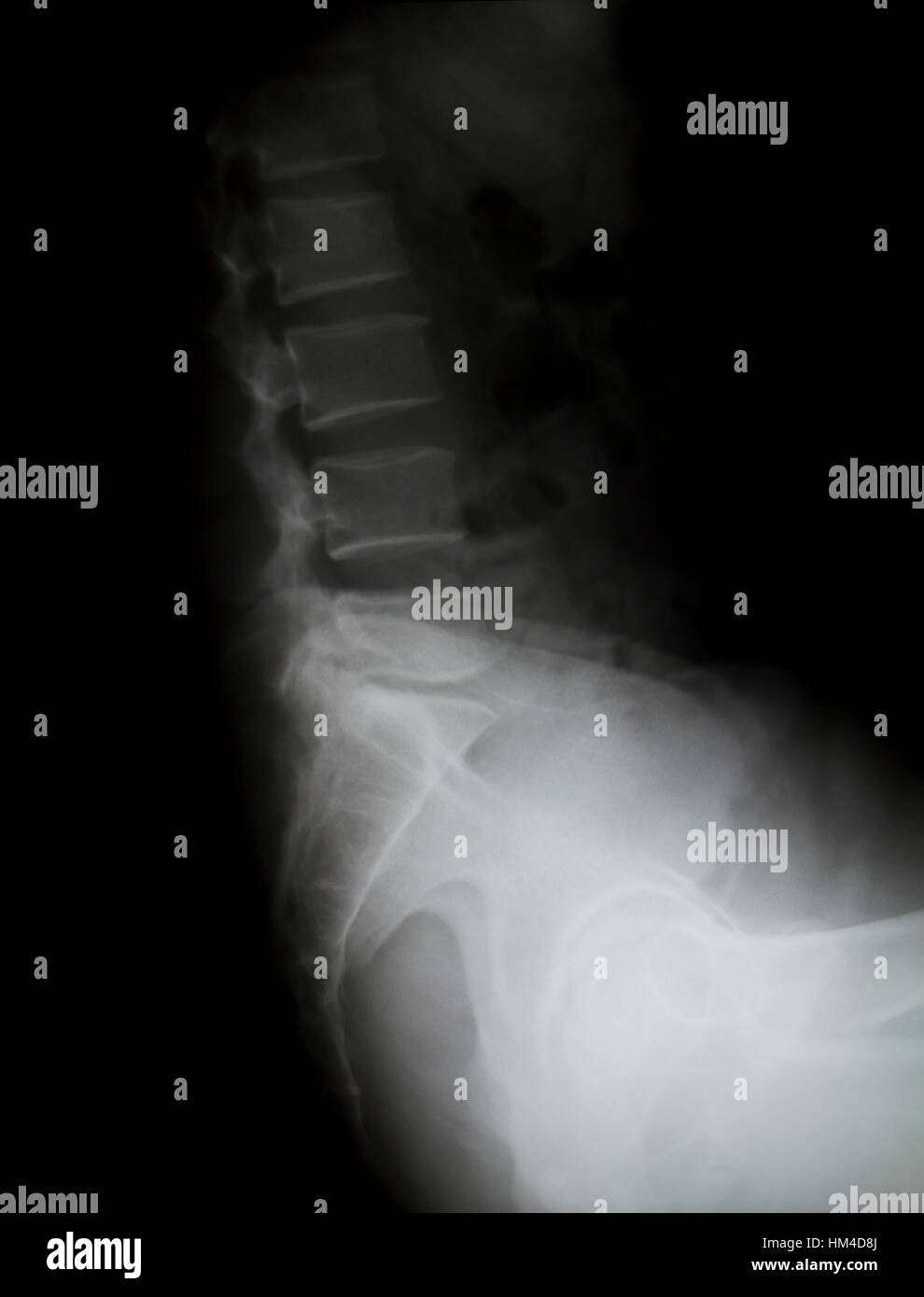 X-ray of the pelvis and spinal column Stock Photo - Alamy