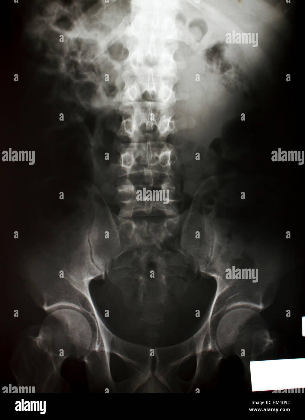 X-ray of the pelvis and spinal column Stock Photo - Alamy