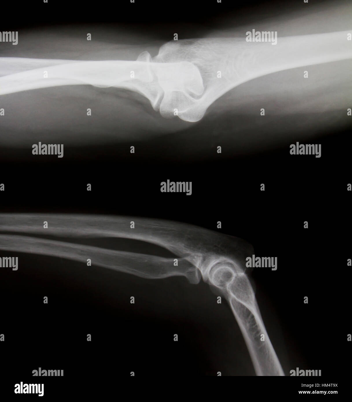 Xray of both human legs (normal legs Stock Photo Alamy