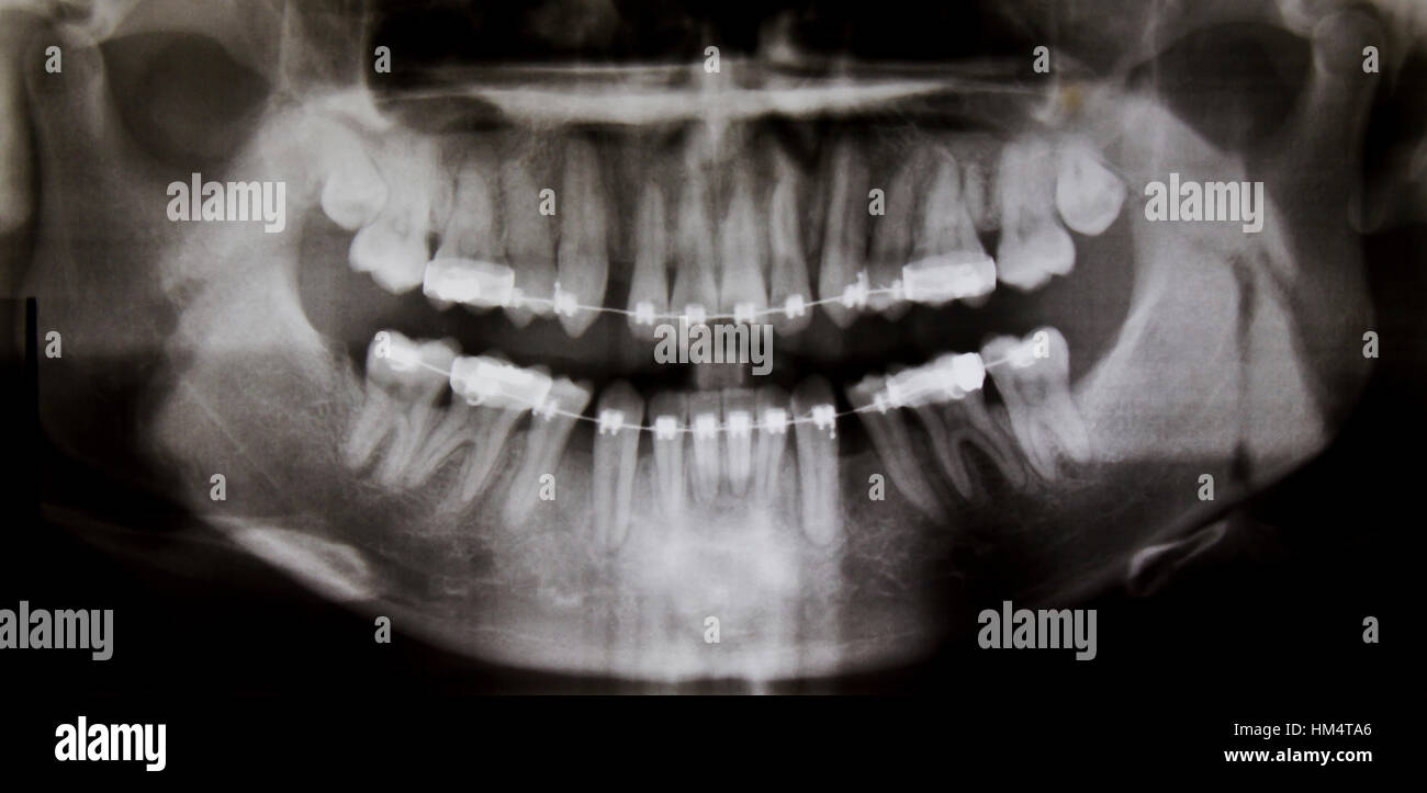 Panoramic dental XRay Stock Photo Alamy