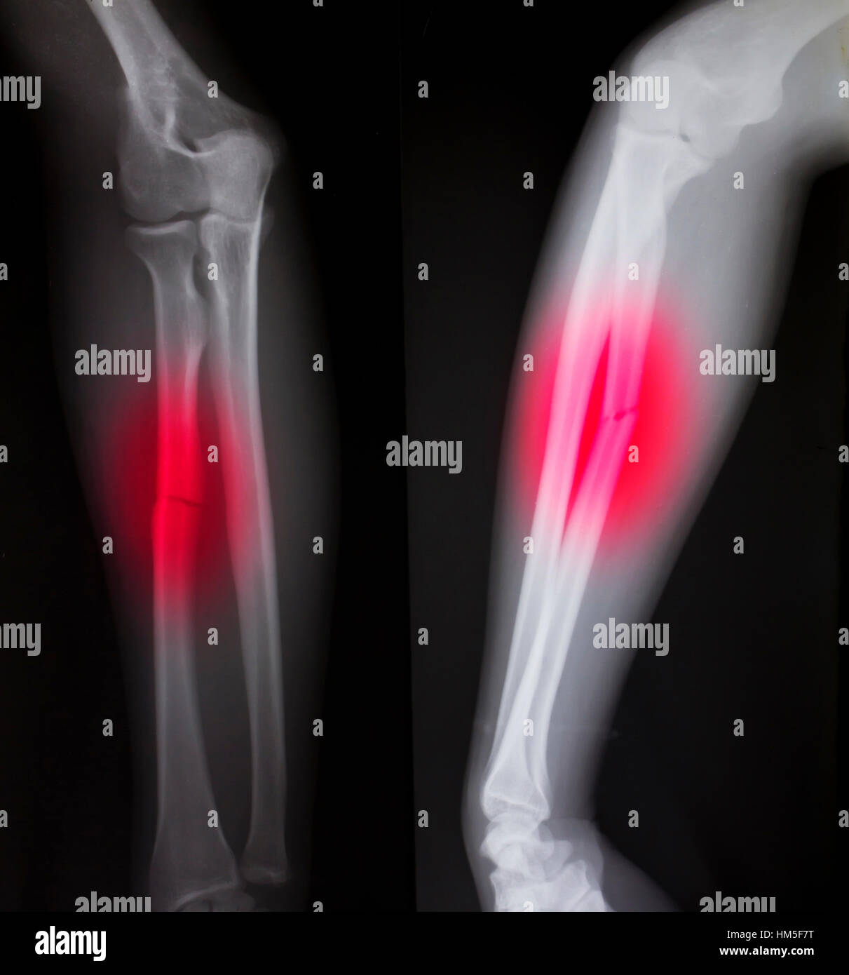 Xray of both human arms (broken arm Stock Photo Alamy
