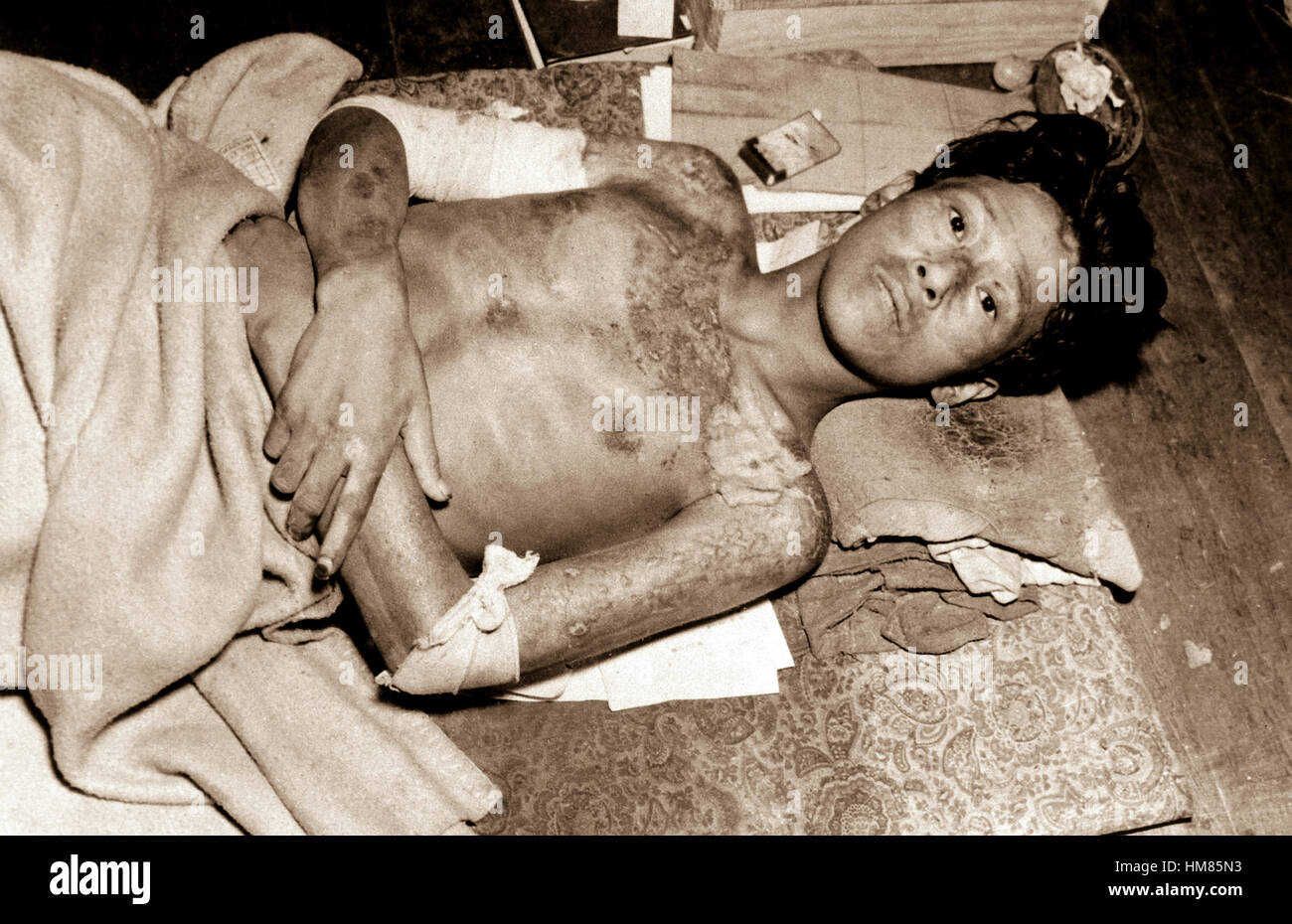 Victim of the Atom Bomb Explosion over Nagasaki.  Ca.  1945. (Corps of Engineers) Exact Date Shot Unknown NARA FILE #:  077-AEC-48-27 WAR & CONFLICT BOOK #:  1245 Stock Photo