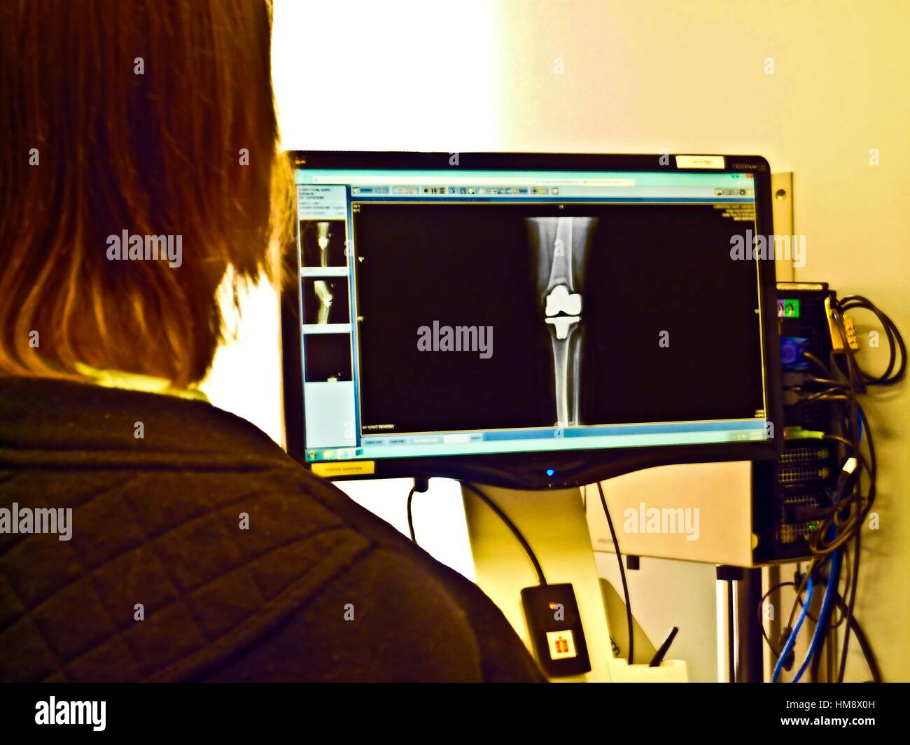 Knee Replacement X Ray Stock Photos Knee Replacement X Ray Stock Knee replacement x ray stock photos knee replacement x ray stock