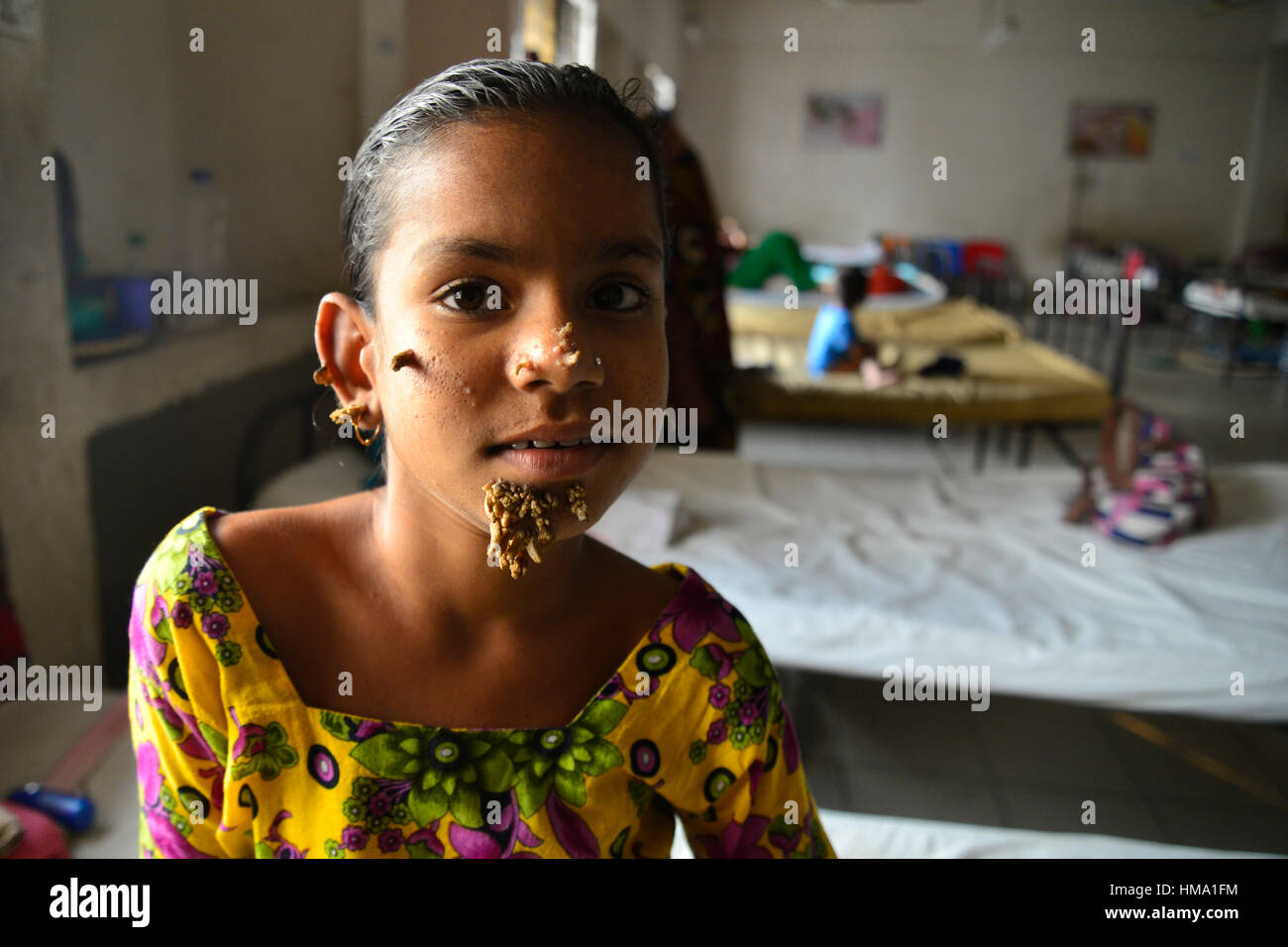 Dhaka, Bangladesh. 1st Feb, 2017. Bangladeshi patient Sahana Khatun, 10, poses for a photograph at the Dhaka Medical College and Hospital. On February 1, 2017 A young Bangladeshi girl with bark-like warts growing on her face could be the first female ever afflicted by so-called 'tree man syndrome', doctors studying the rare condition said January 31. Ten-year-old Sahana Khatun has the tell-tale gnarled growths sprouting from her chin, ear and nose, but doctors at Dhaka's Medical College Hospital are still conducting tests to establish if she has the unusual skin disorder. Credit: Mamunur Rashi Stock Photo