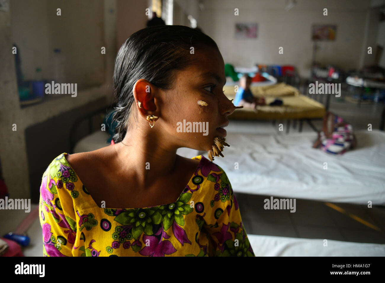 Dhaka, Bangladesh. 1st Feb, 2017. Bangladeshi patient Sahana Khatun, 10, poses for a photograph at the Dhaka Medical College and Hospital. On February 1, 2017 A young Bangladeshi girl with bark-like warts growing on her face could be the first female ever afflicted by so-called 'tree man syndrome', doctors studying the rare condition said January 31. Ten-year-old Sahana Khatun has the tell-tale gnarled growths sprouting from her chin, ear and nose, but doctors at Dhaka's Medical College Hospital are still conducting tests to establish if she has the unusual skin disorder. Credit: Mamunur Rashi Stock Photo