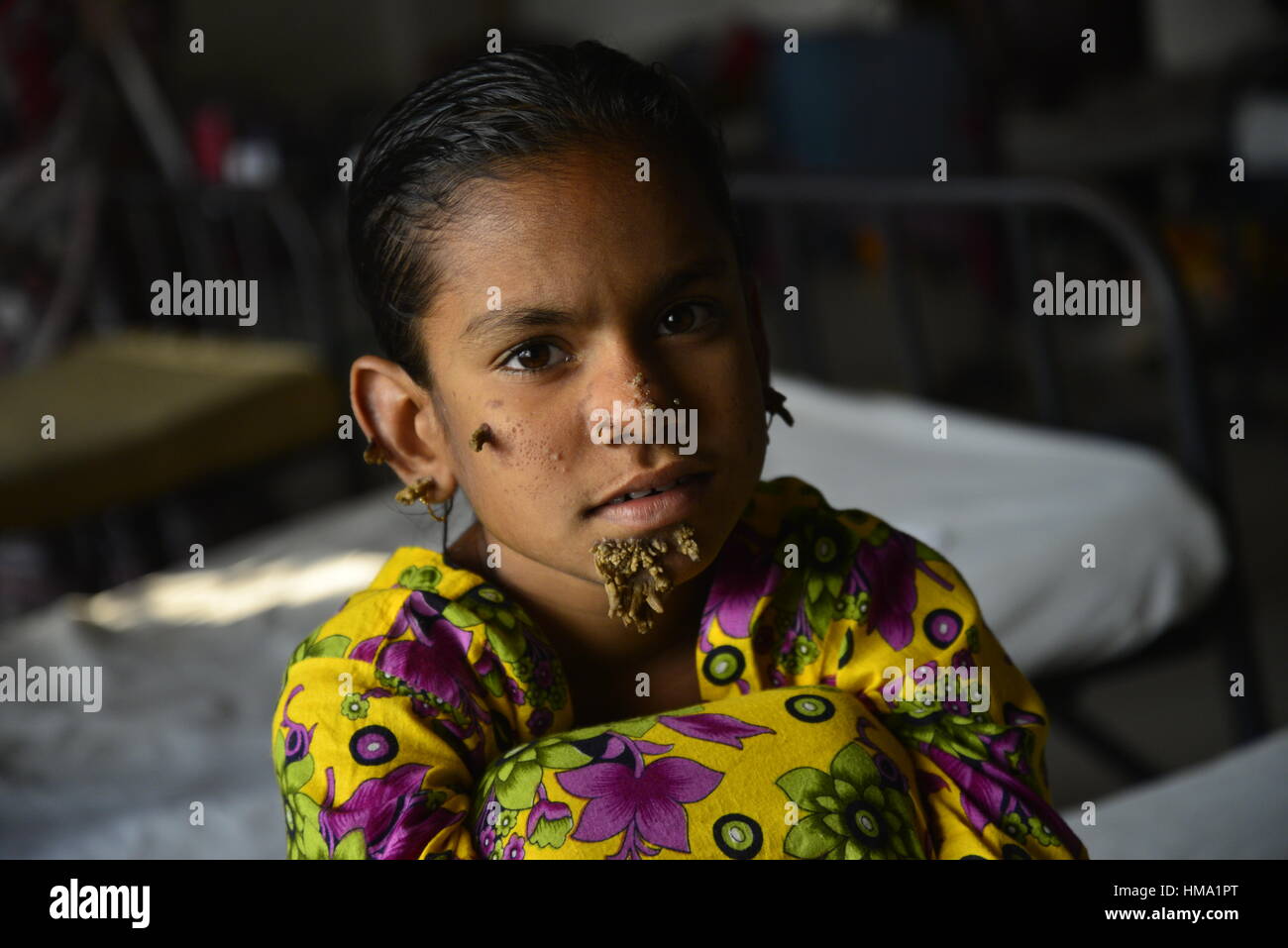 Bangladeshi patient Sahana Khatun, 10, poses for a photograph at the Dhaka Medical College and Hospital. On February 1, 2017 A young Bangladeshi girl with bark-like warts growing on her face could be the first female ever afflicted by so-called 'tree man syndrome', doctors studying the rare condition said January 31. Ten-year-old Sahana Khatun has the tell-tale gnarled growths sprouting from her chin, ear and nose, but doctors at Dhaka's Medical College Hospital are still conducting tests to establish if she has the unusual skin disorder. Stock Photo