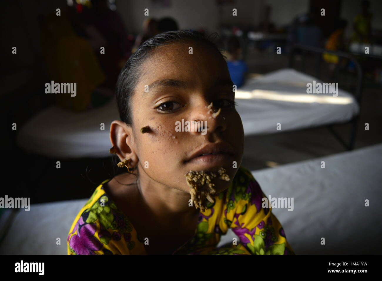 Bangladeshi patient Sahana Khatun, 10, poses for a photograph at the Dhaka Medical College and Hospital. On February 1, 2017 A young Bangladeshi girl with bark-like warts growing on her face could be the first female ever afflicted by so-called 'tree man syndrome', doctors studying the rare condition said January 31. Ten-year-old Sahana Khatun has the tell-tale gnarled growths sprouting from her chin, ear and nose, but doctors at Dhaka's Medical College Hospital are still conducting tests to establish if she has the unusual skin disorder. Stock Photo