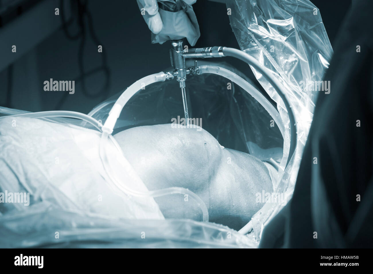 Knee keyhole surgery hospital arthroscopy operation medical procedure