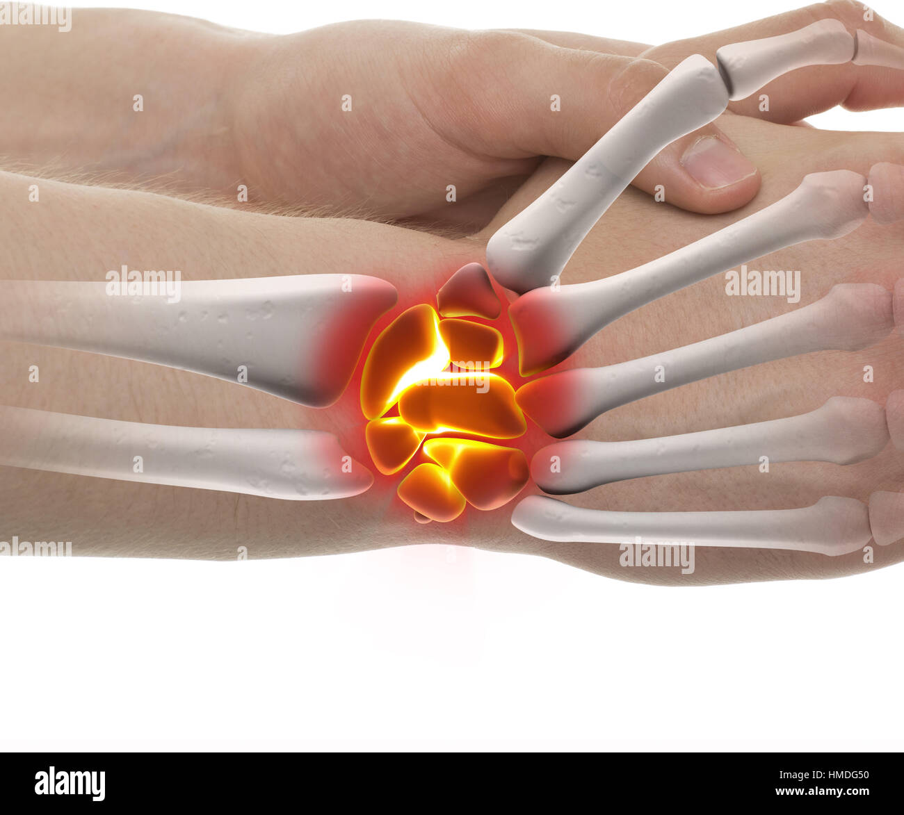 Wrist Fracture - Studio shot with 3D illustration isolated on white Stock Photo