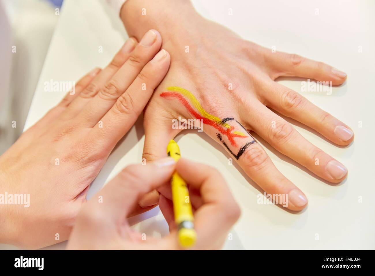 Hand. Flap. Hand surgery. In reconstructive surgery tips, flaps is one