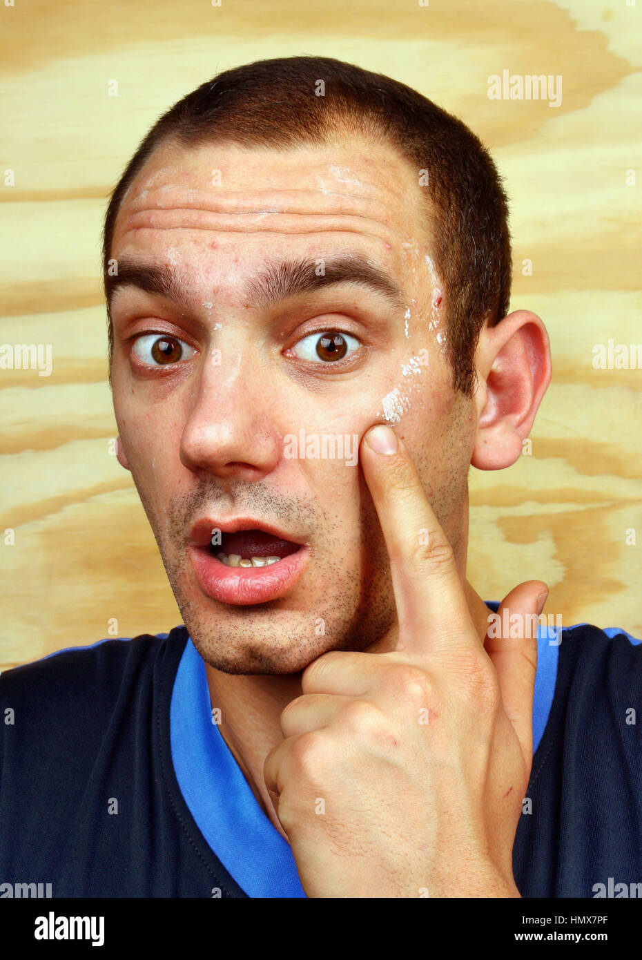 Young man with a chronic infection of the skin on the face Stock Photo