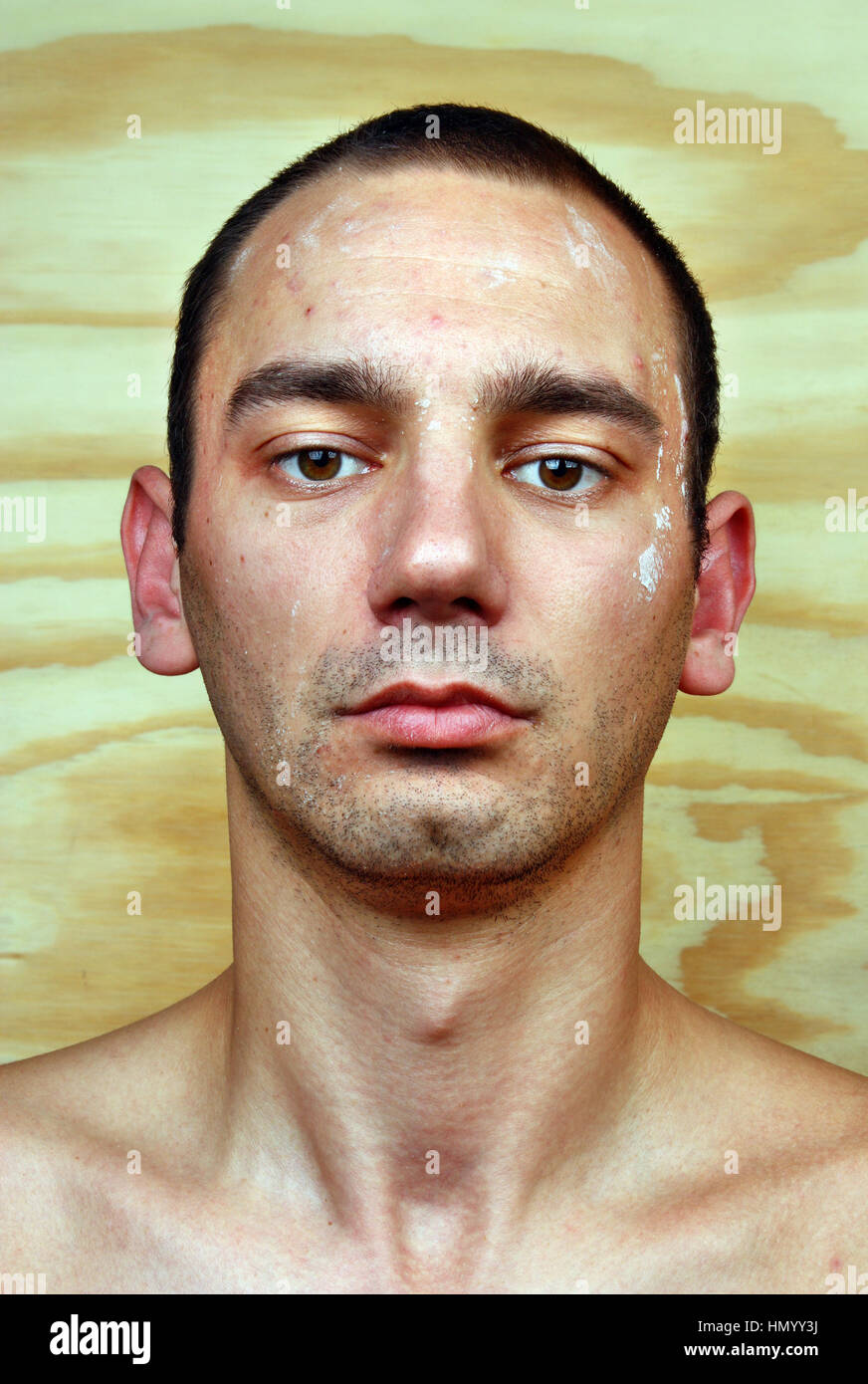 Young man with a chronic infection of the skin on the face Stock Photo ...