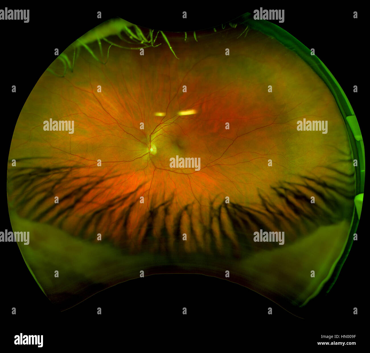 An ultra wide digital retinal scan of a human eye showing the veins and capillaries in a retina. Stock Photo