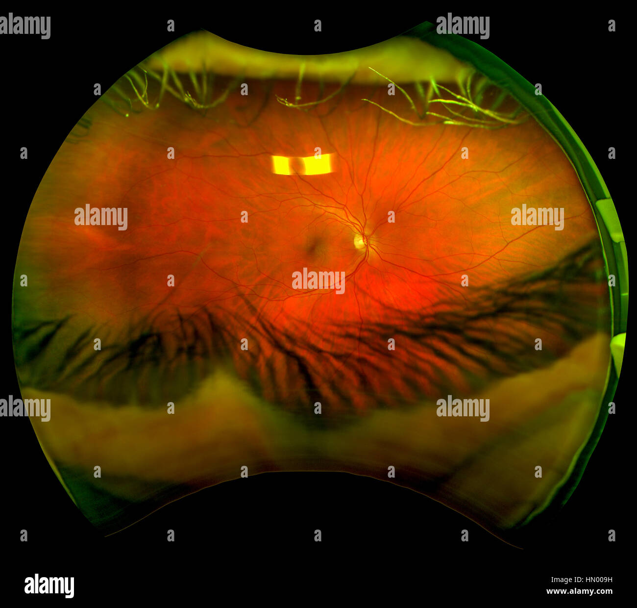 An ultra wide digital retinal scan of a human eye showing the veins and capillaries in a retina. Stock Photo