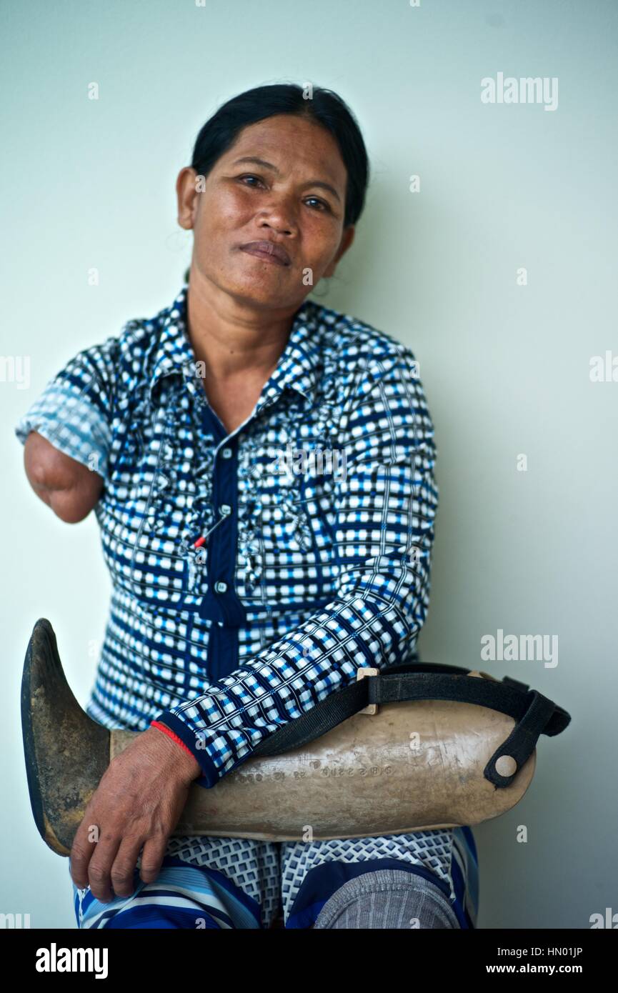 Model released portrait of a Cambodian land mine survivor, who lost an arm and a leg, now using