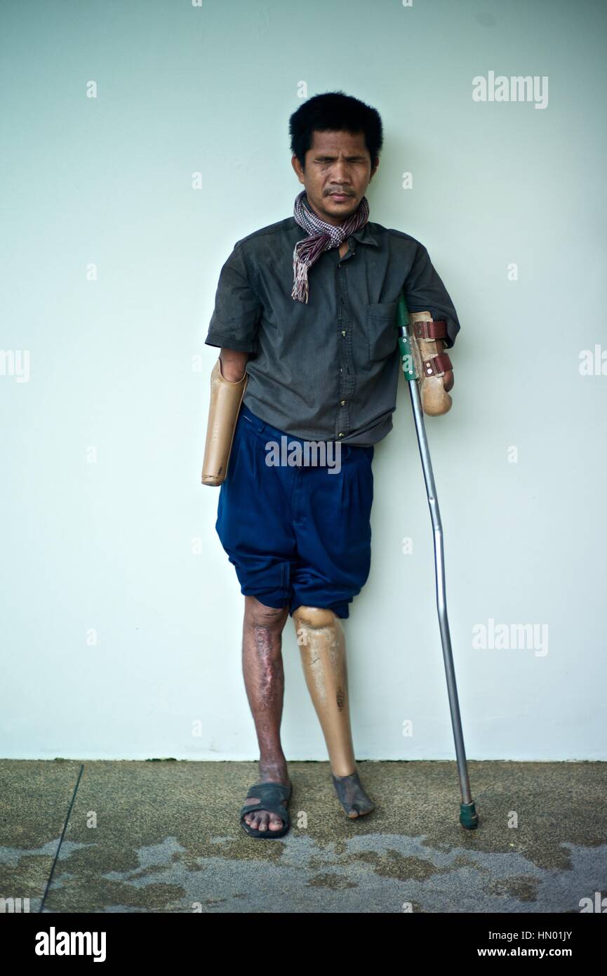 Model released portrait of a Cambodian land mine survivor, who lost Stock  Photo - Alamy