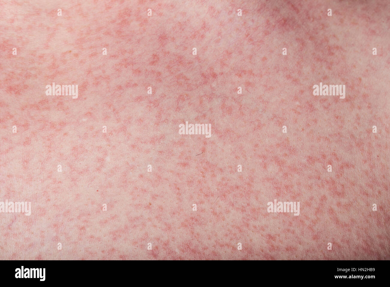 macro of skin with rash from dengue disease Stock Photo