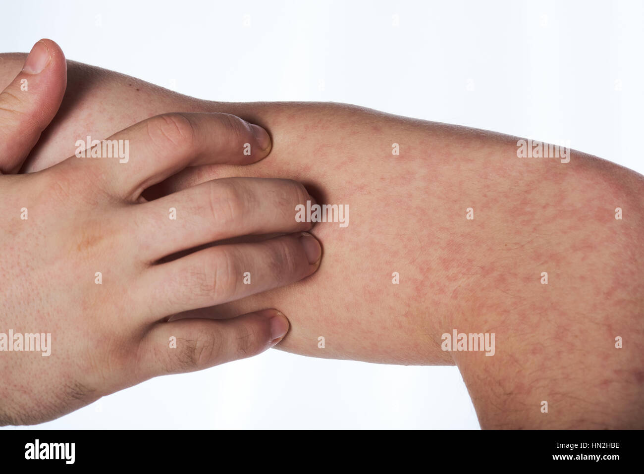 Scratching hand with allergy rash isolated on white Stock Photo