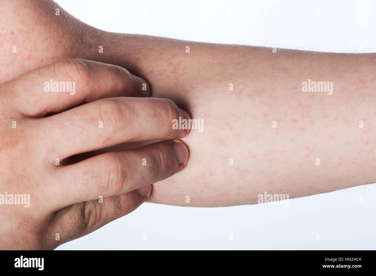 close up of hand with rash isolated on white Stock Photo