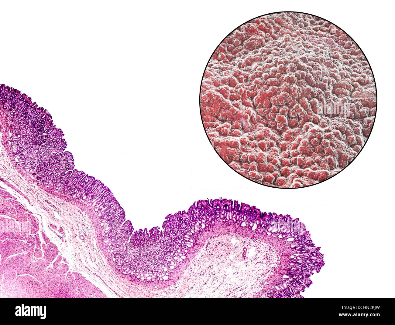 Stomach mucosa. Light micrograph (bottom left) and computer illustration (top right) of the lining of the stomach, known as the mucosa. The stomach is a muscular sac involved in storage and digestion of food. The surface of the mucosa consists of simple columnar cells (dark purple in micrograph) that secrete mucus. The mucus protects the stomach lining from digestive acids and enzymes that act on food in the stomach. Beneath the columnar cells are gastric pits, the glands that make the acids and enzymes needed to digest food. Stock Photo