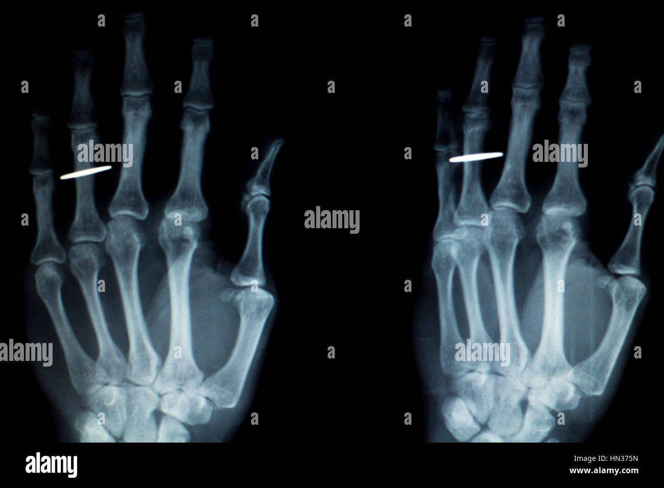 Orthopedics Hand finger joint meniscus, ligament, tendon and cartilage injury titanium modern metal implant X-ray scan. Stock Photo