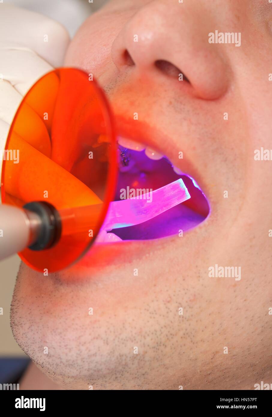 Dentist working with dental polymerization lamp in oral cavity Stock Photo Alamy