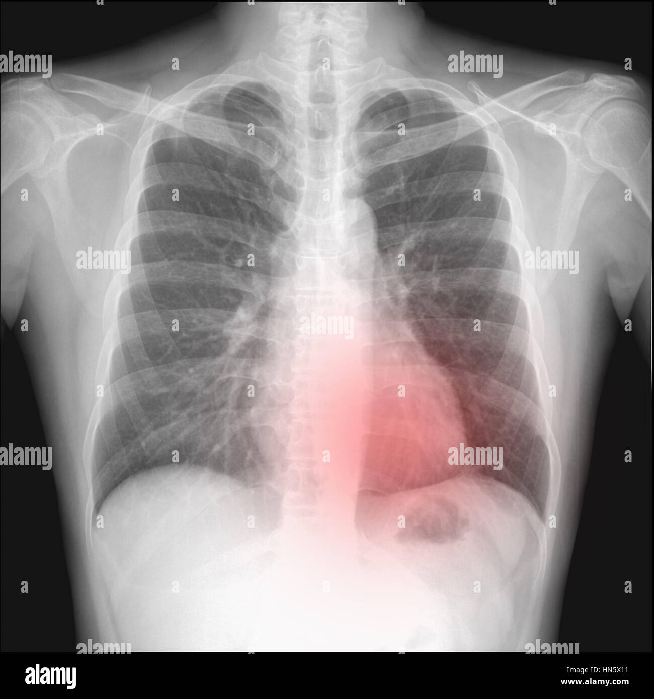 Pneumothorax High Resolution Stock Photography and Images ...