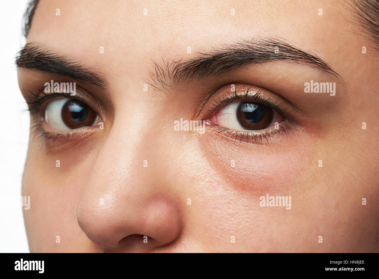 close up of young woman with red eye isolated on white Stock Photo
