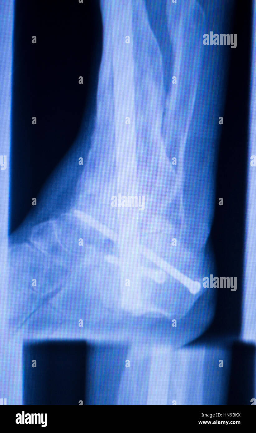 Xray foot heel ankle test scan results showing orthopedic titanium