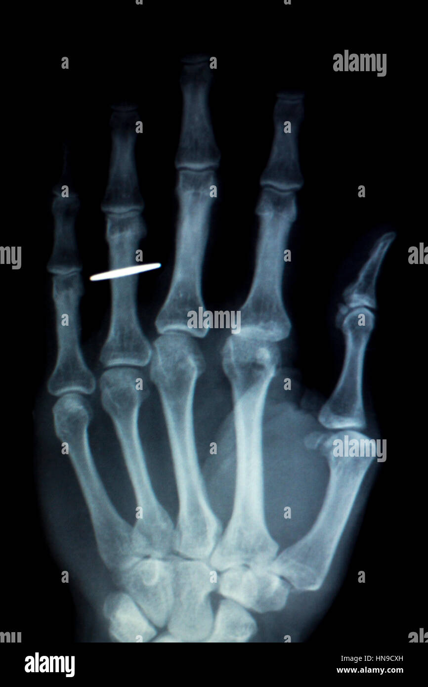 Orthopedics Hand finger joint meniscus, ligament, tendon and cartilage injury titanium modern metal implant X-ray scan. Stock Photo