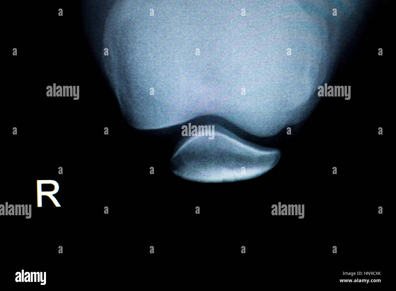 Orthopedics knee joint meniscus, ligament, tendon and cartilage injury