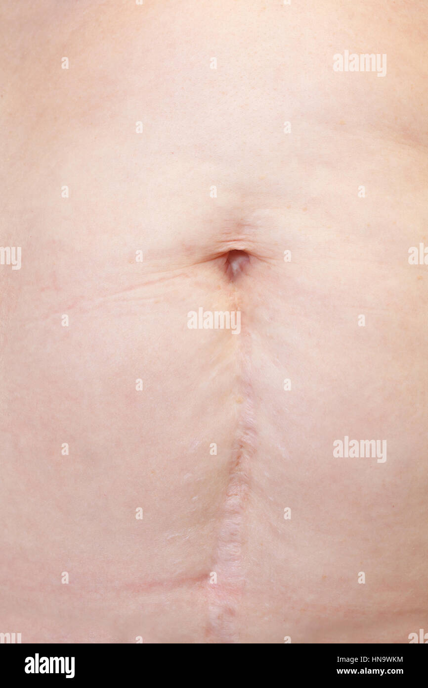 Close-up of a woman with a cesarean Stock Photo