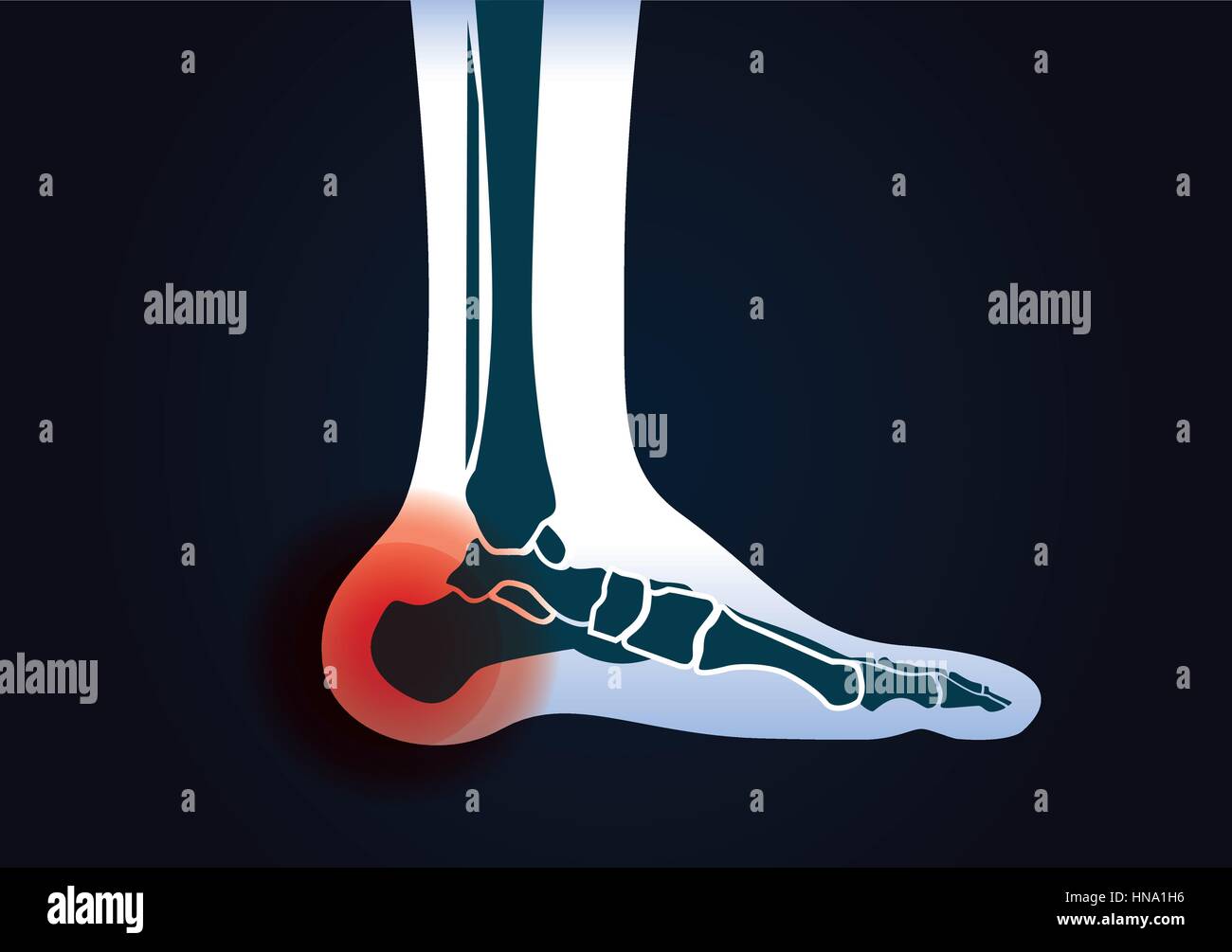 Red signal at heel area. This illustration about human foot injury. Stock Vector